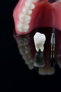 About Dental Implants to Laymen