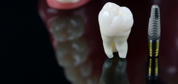 About Dental Implants to Laymen