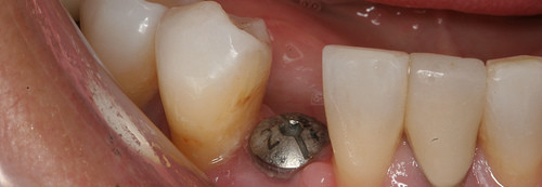 The Different Aspects of Dental Implants
