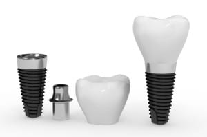 B & W implant components crown