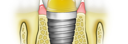 Are dental implants reliable?