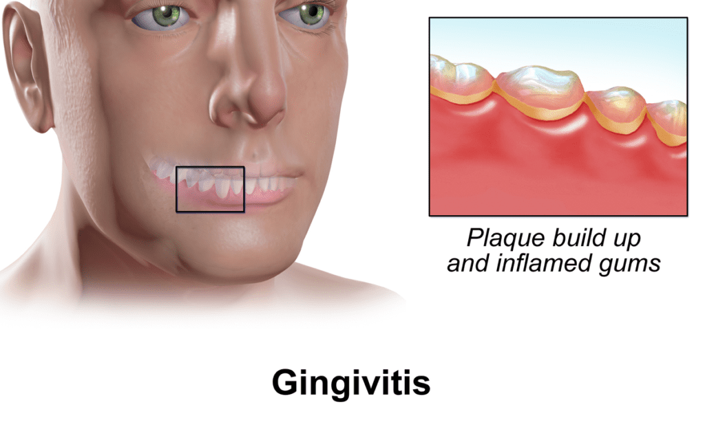 What Causes Swollen Gums?