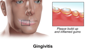 Gum Disease: What Causes Swollen Gums?