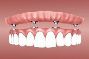 What are Dental Implants?