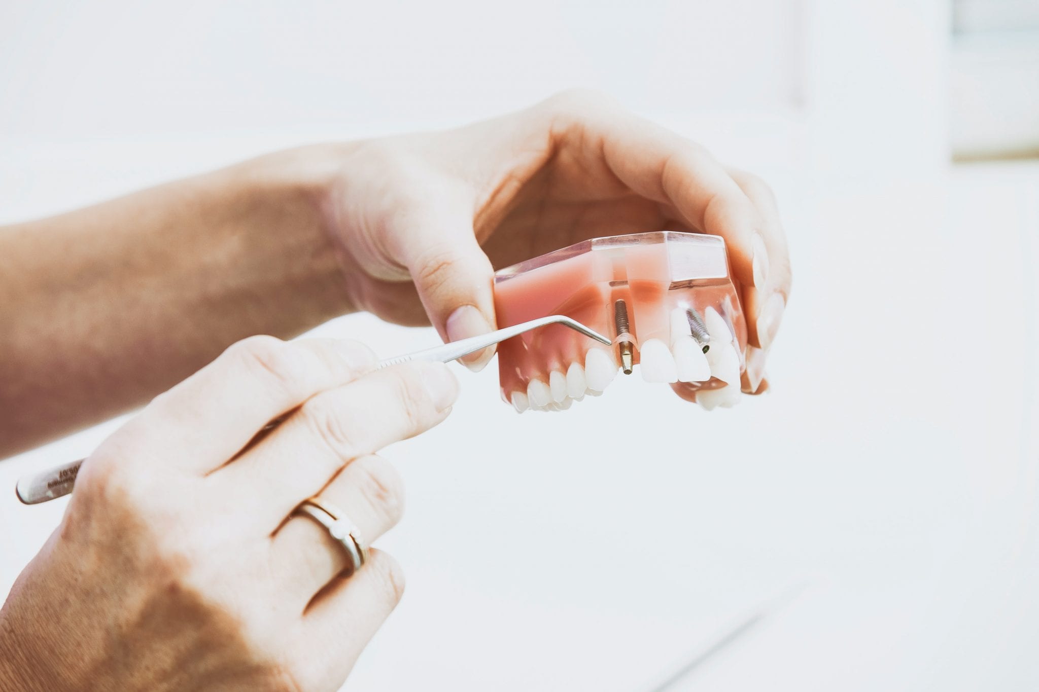 Technological Advantages of Dental Implants