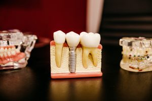 Wisdom Teeth: Should I Have My Wisdom Teeth Removed?
