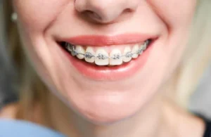 Braces: The Journey to a Healthier, Confident Smile